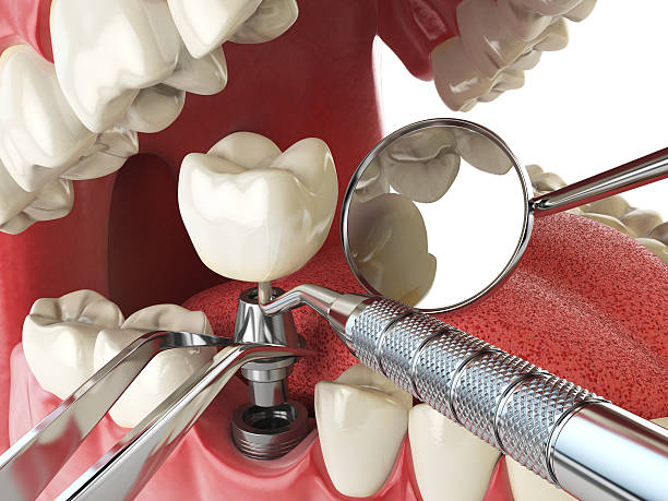 Best Emergency Tooth Extraction in Archer, FL
